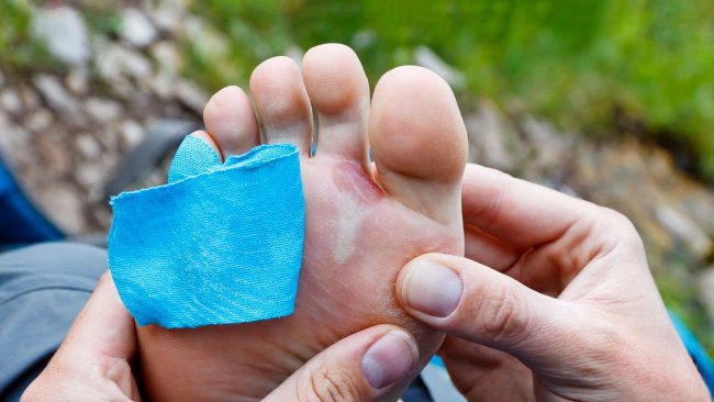 hiking blisters