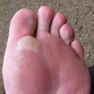 Foot Blister Prevention & Treatment: The Complete Guide | TheGearHunt