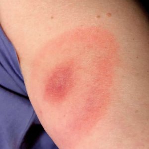 Spider Bites On Arm Treatment