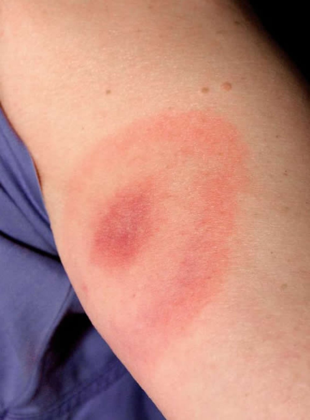 What To Do After A Black Widow Bite How To Remove A Tick Head Stuck 